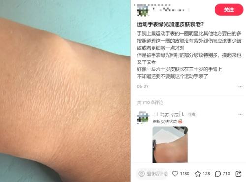 手腕戴出一圈“白印子”，智能手表还能不能放心戴？你现在戴智能手表吗？